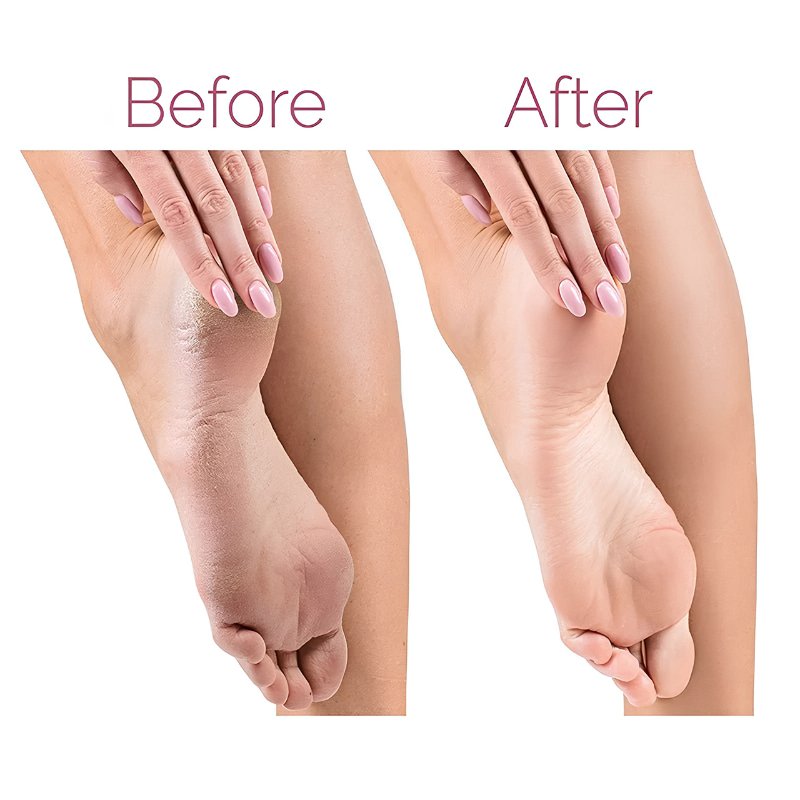 Electric Callus Remover for Feet – Rechargeable Pedicure Tool for Dead Skin & Cracked Heels Removal